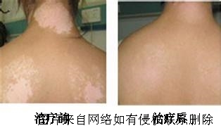 白癜风有什么样的危害