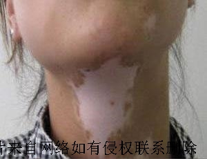 白癜风主要的危害性表现有哪些呢