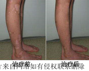 儿童白癜风的危害具体都有什么