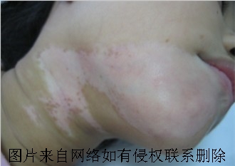 白癜风会造成怎样的危害