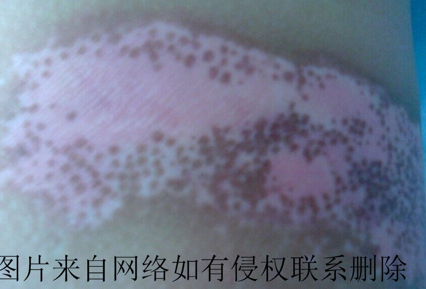 白癜风可以治好吗