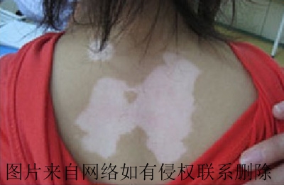 腿部白癜风怎么治疗有效