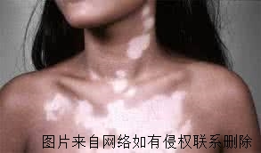 局限性白癜风能治好吗