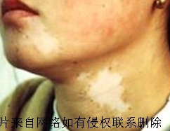 治疗白癜风有哪些方法