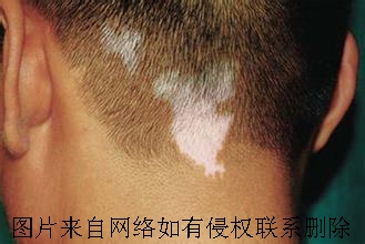 白癜风在早期的时候能被治愈吗