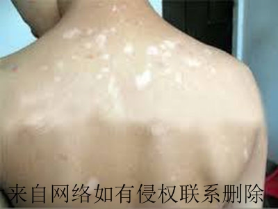 白癜风的典型特征有哪些