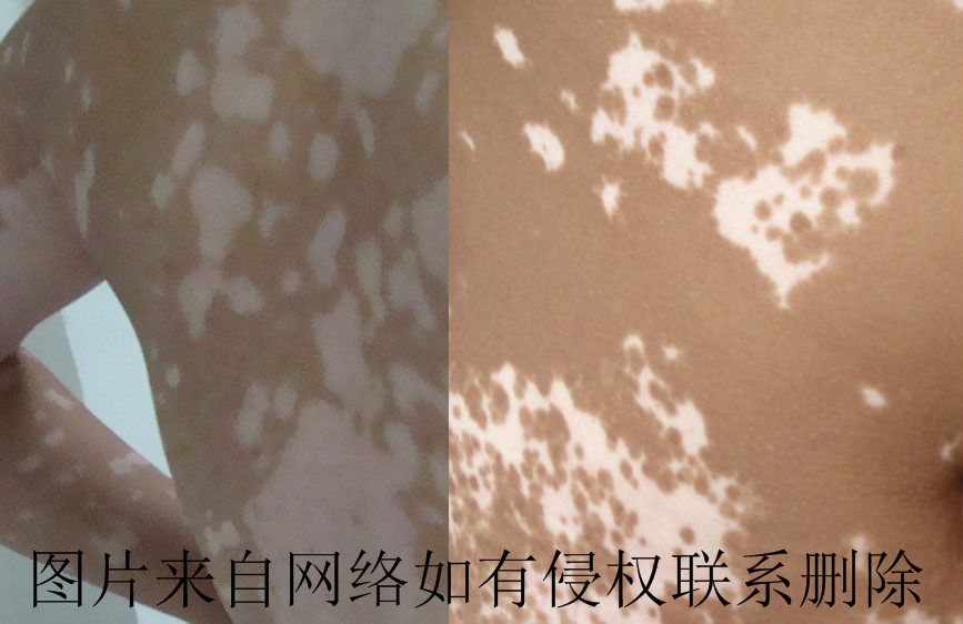 白癜风早期症状是什么