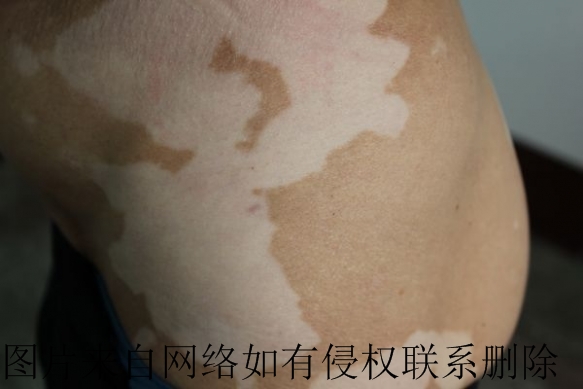 初期白癜风是什么症状